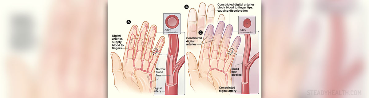 Homeopathic remedy for raynaud's disease | General center