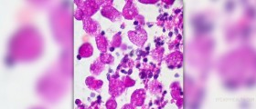 Homeopathic remedy for ulcerative colitis