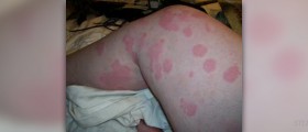 Homeopathic remedy for urticaria