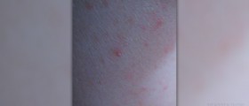 Hot tub rash
