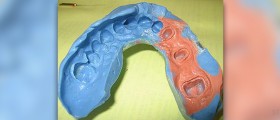 How are dental implants done