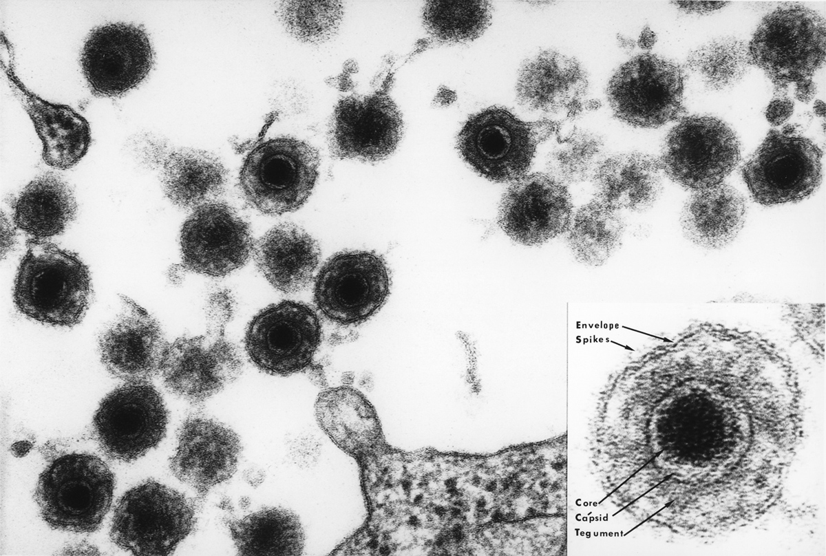 Mononucleosis Long Term Effects