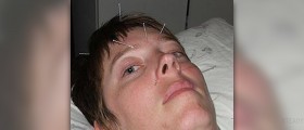 How does acupuncture work?