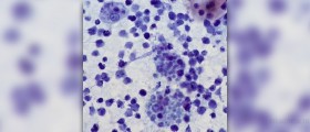 How is lymphoma diagnosed