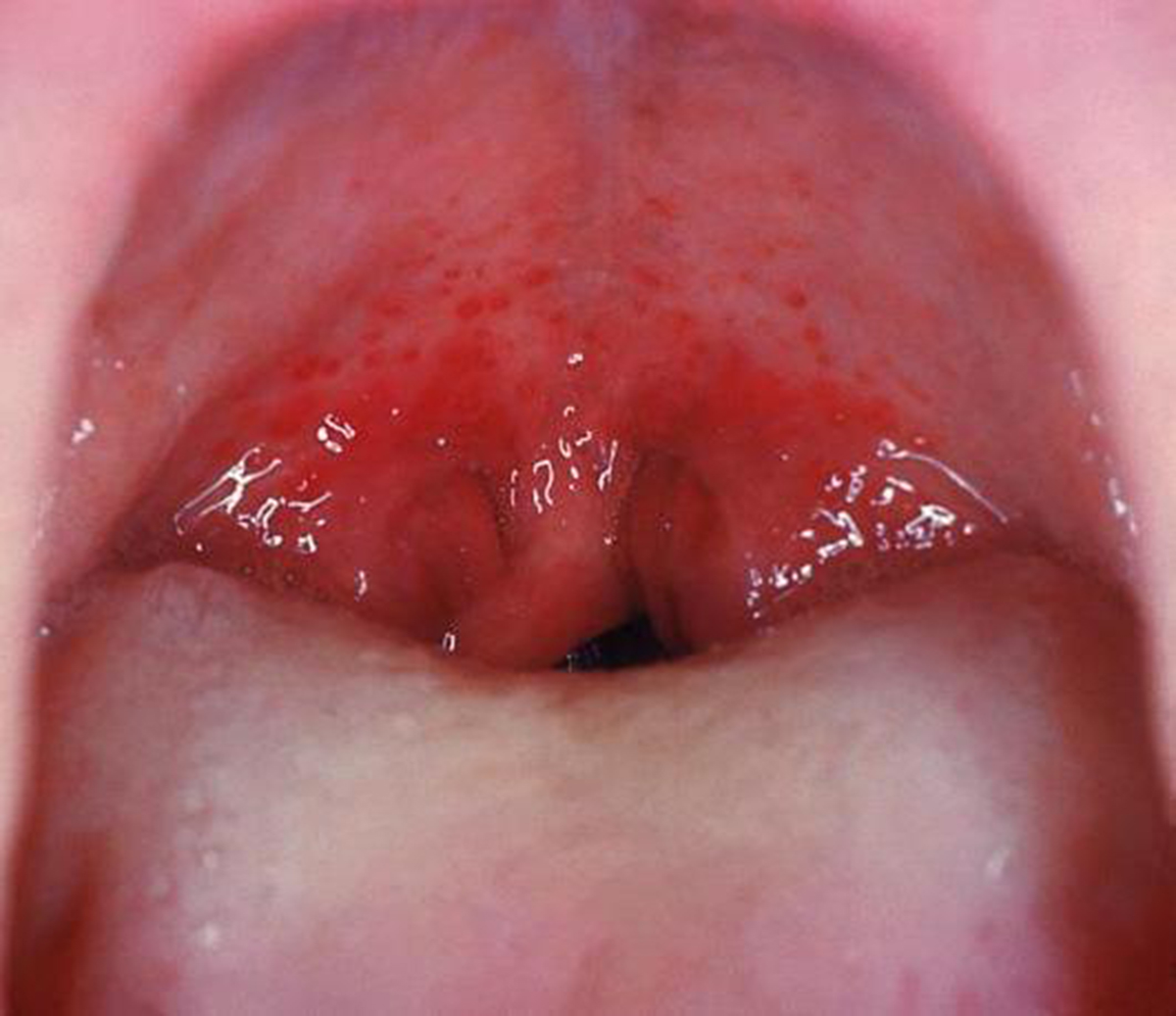 How long does strep throat last | General center ...