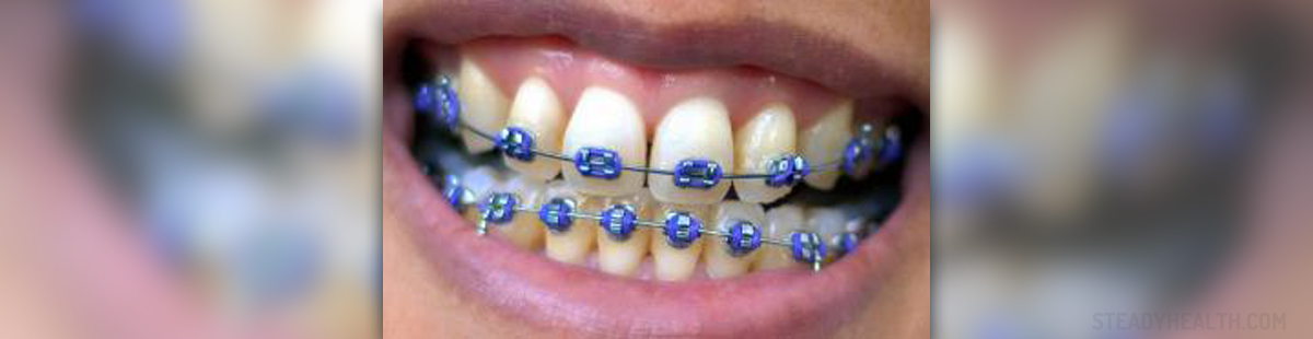 How much do braces cost? | General center | SteadyHealth.com