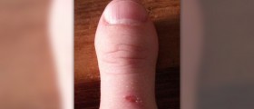 How to care and cure thumb arthritis
