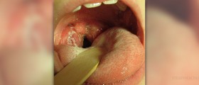 How to cure strep throat