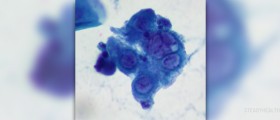 How to discover genital herpes in men