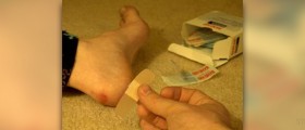 How to get rid of blisters