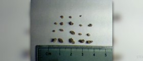 How to get rid of kidney stones