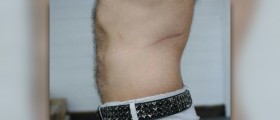 How to get rid of scars