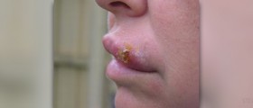 How to heal a cold sore
