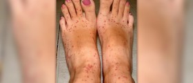 How to treat a allergic reaction