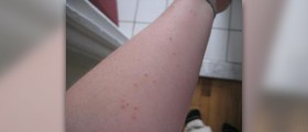 How to treat a bed bug bite