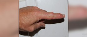 How to treat a bee or wasp sting
