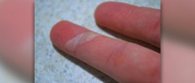 How to treat a burn blister