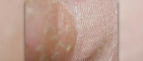 How to treat a callus