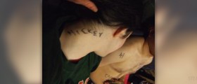 How to treat a hickey