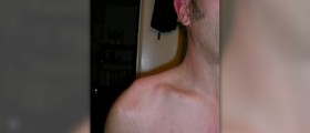 How to treat a hurt shoulder