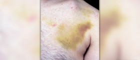 How to treat a rib fracture
