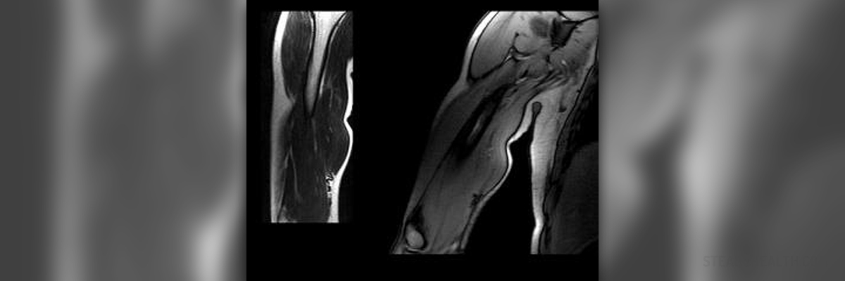 achilles-tendon-rupture-quick-review-orthopaedicprinciples