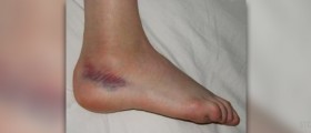 How to treat a sprain