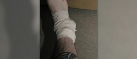 How to treat a sprained ankle