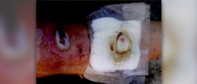 How to treat a staph infection