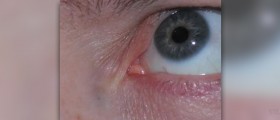 How to treat a stye in eye