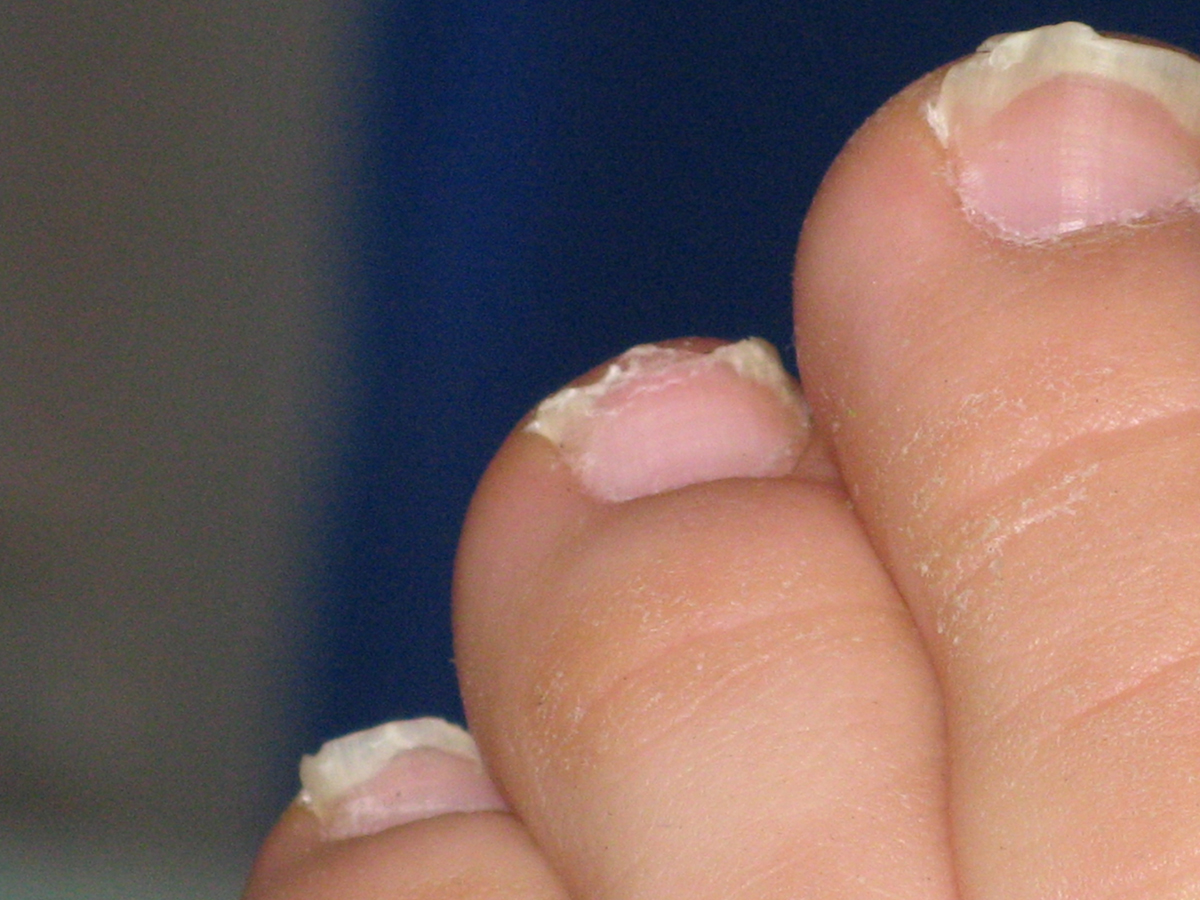 Can An Infected Toe Make You Feel Ill