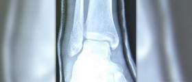 How to treat sternal fractures