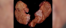 Hyperactive thyroid symptoms