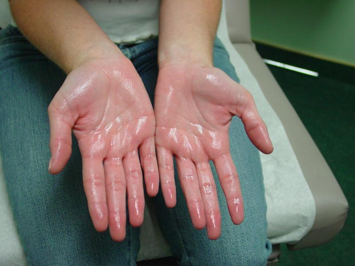 Hyperhidrosis symptoms facts