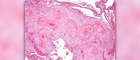 Hypertrophic cardiomyopathy information