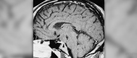 Hypothalamic disorders facts