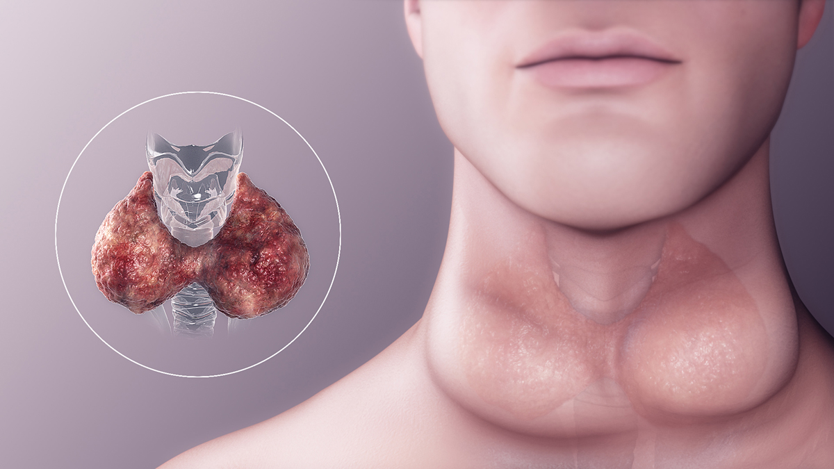 complications-of-hypothyroidism-general-center-steadyhealth