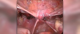 Hysterectomy and complications