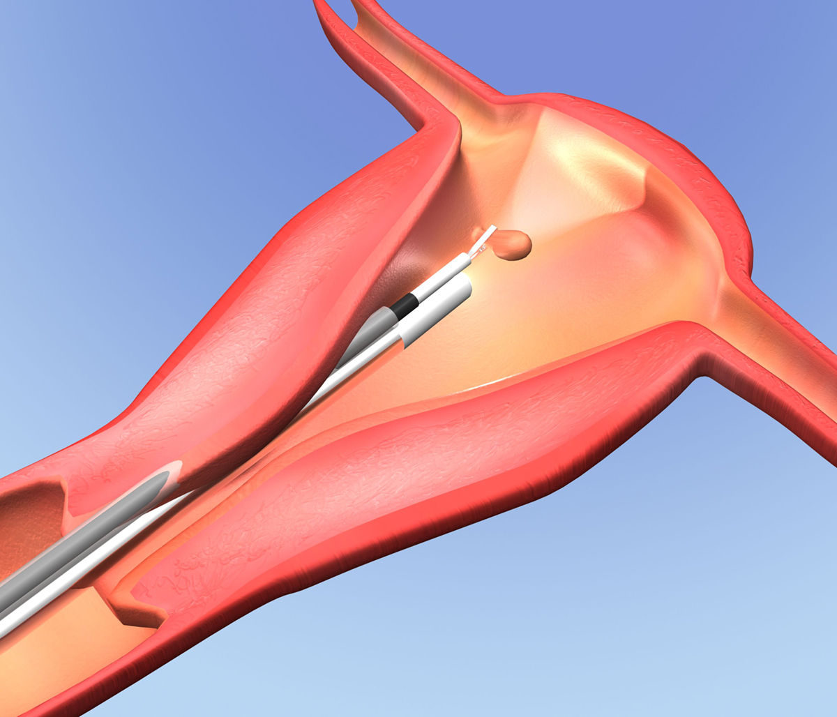 Complications Of Hysteroscopy General Center SteadyHealth