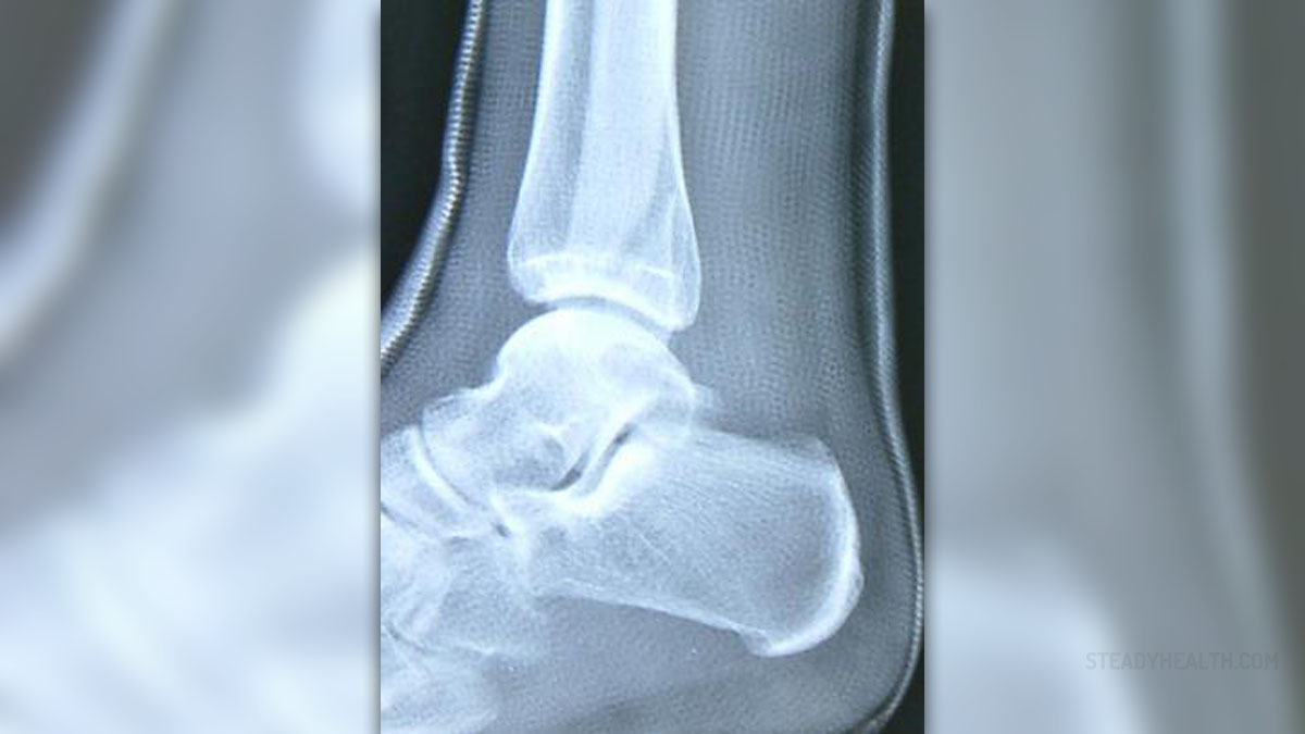 impacted fracture