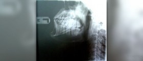 Impacted wisdom teeth symptoms