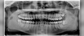 Impacted wisdom teeth