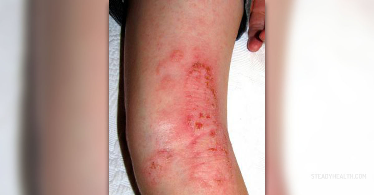 Impetigo rash facts | General center | SteadyHealth.com