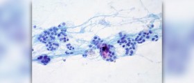 Inactive thyroid in men
