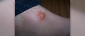 Infected blister facts