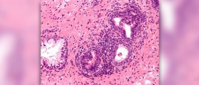 Chronic nonbacterial prostatitis