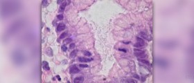 Inflammation of the stomach lining - gastritis