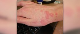 Information about cures for scabies
