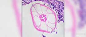 Information about pinworms in humans
