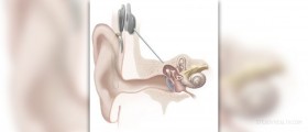 Information on cochlear implant